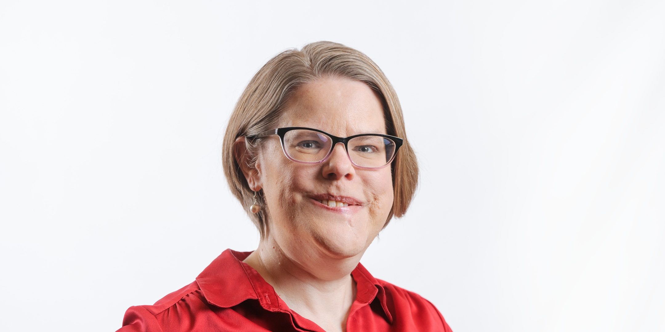 Our Book of the Month Cassandra, sharing about facial disfigurement.